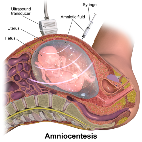 Amniocentesis