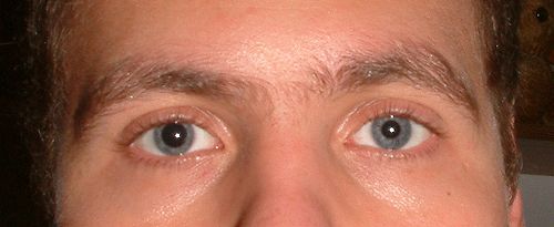 Anisocoria