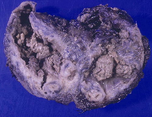 Aspergilloma