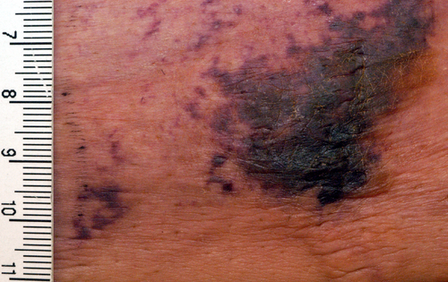 Calciphylaxis