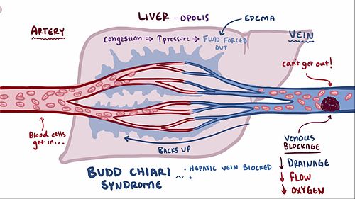 Ischemia