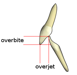 Overjet