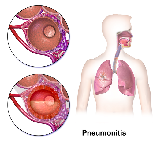 Pneumonitis