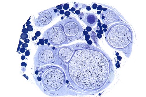 Polyneuropathy