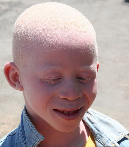 albinism