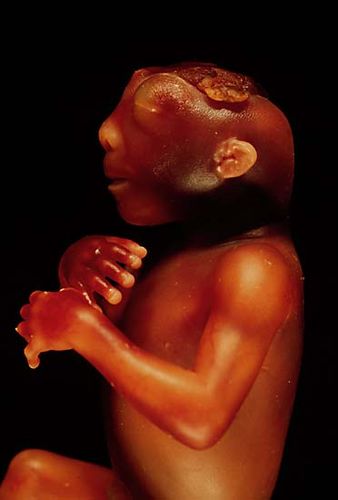 anencephaly