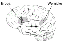 aphasia