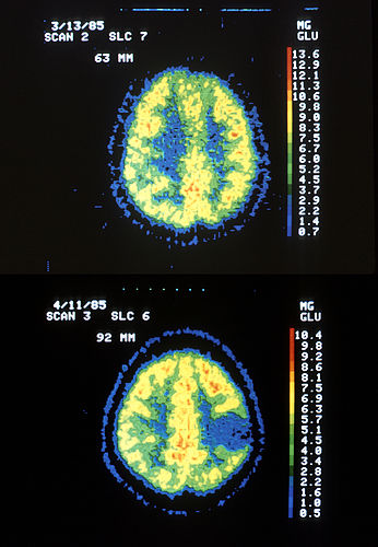 astrocytoma