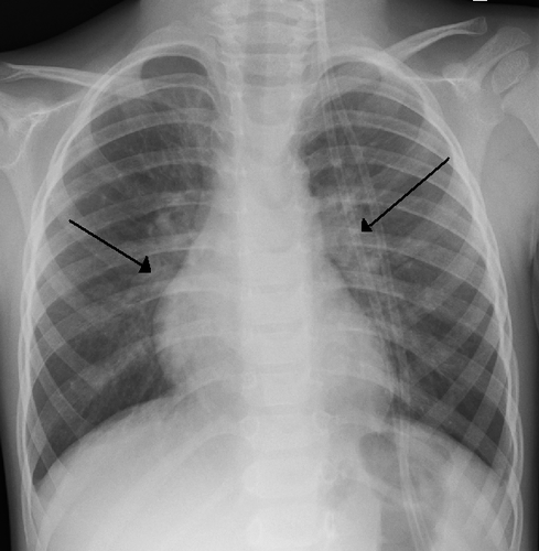 bronchiolitis