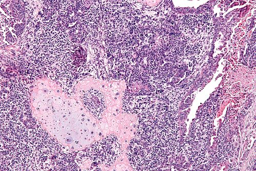 carcinosarcoma