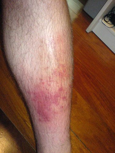 cellulitis