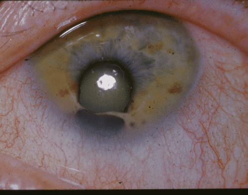 coloboma