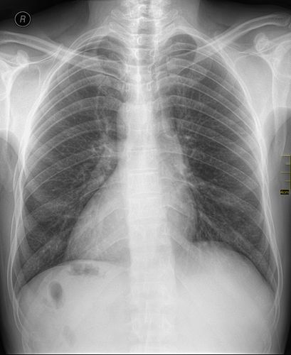 dextrocardia