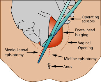 episiotomy