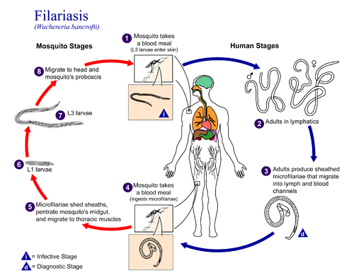 filariasis