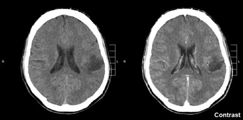 glioma