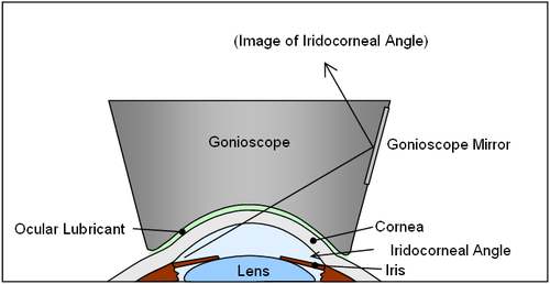 gonioscopy