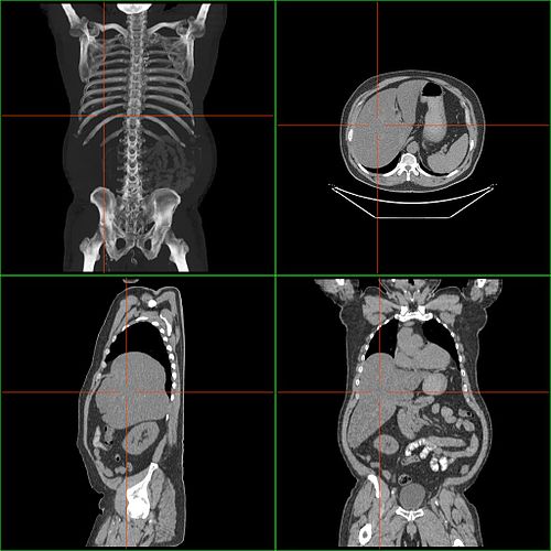 hepatomegaly