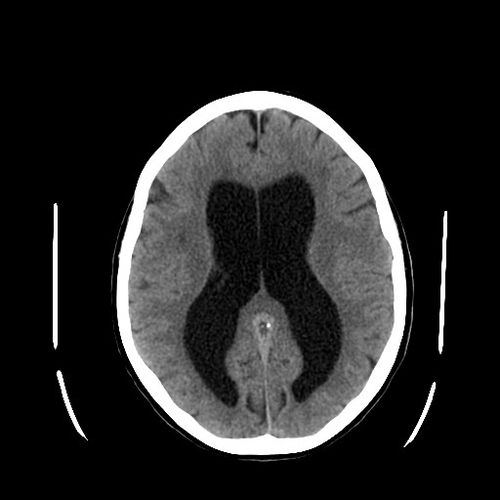 hydrocephalus