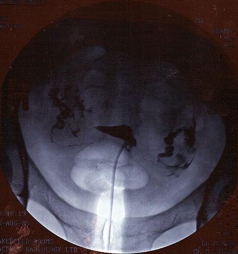 hysterosalpingography