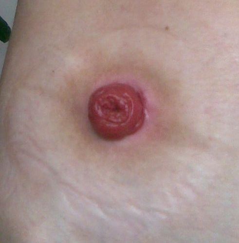 ileostomy