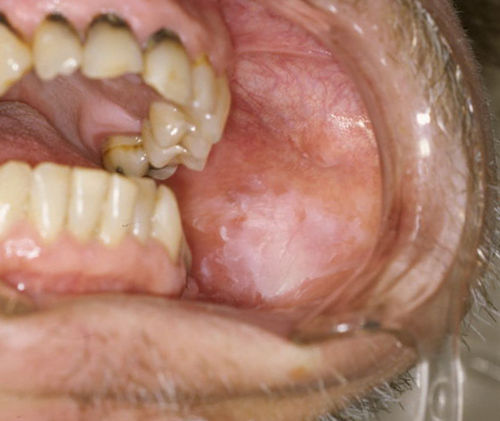 leukoplakia