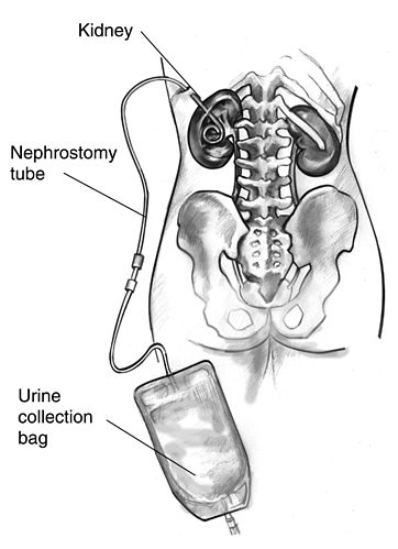 nephrostomy