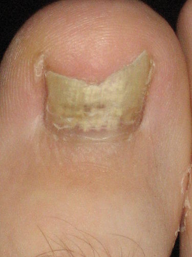 onychomycosis