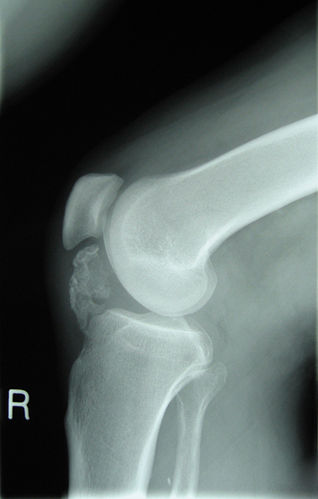 osteochondroma