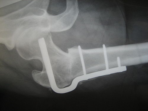 osteotomy