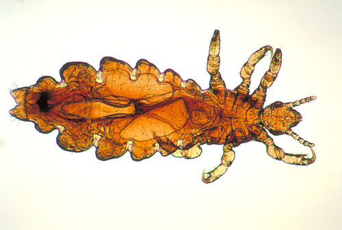 pediculosis