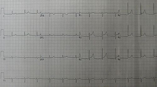 pericarditis