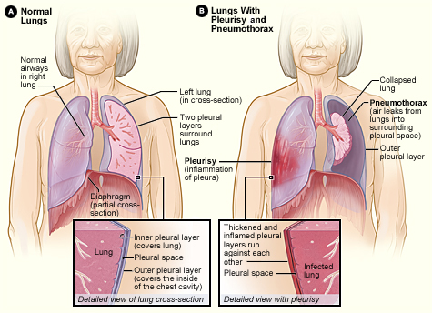 pleurisy