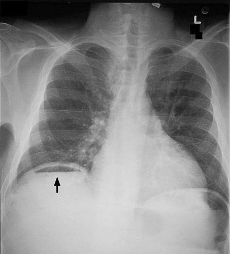 pneumoperitoneum