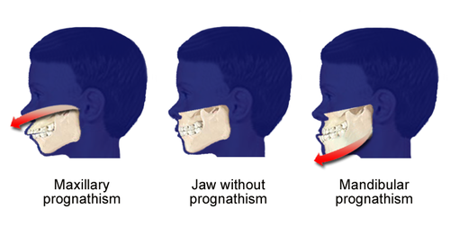 prognathism