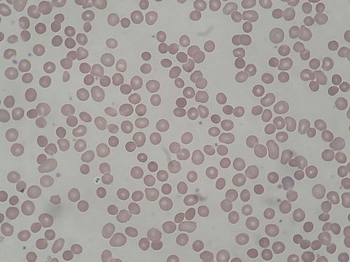 spherocytosis