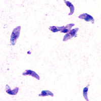 toxoplasmosis