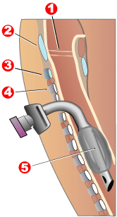 tracheotomy