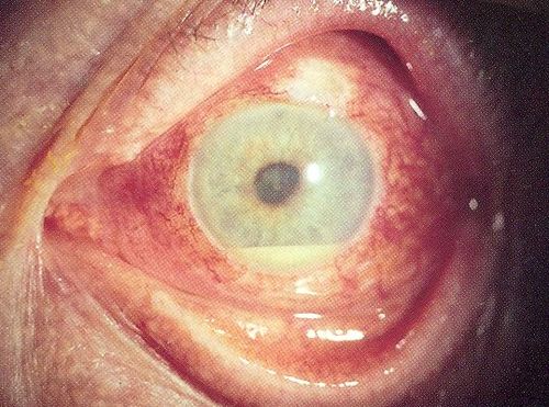 uveitis