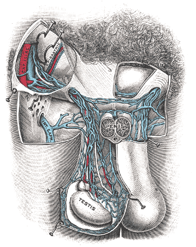 varicocele