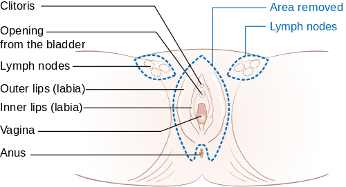 vulvectomy