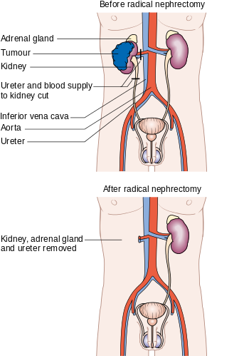 Nephrectomy  Polski Meaning of Nephrectomy