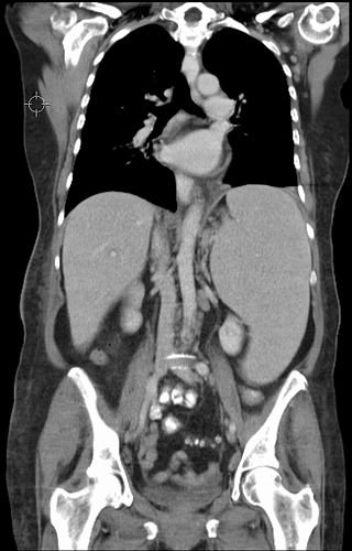 splenomegaly-japanese-meaning-of-splenomegaly